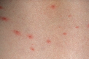 Acne of Folliculitis