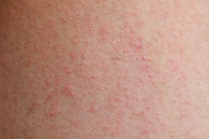 Keratosis Pilaris