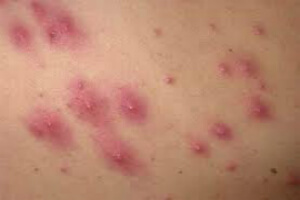 Hidradenitis suppurativa